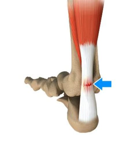 Achilles Tendon Rupture Bunbury Foot Ankle Surgeon | Hot Sex Picture