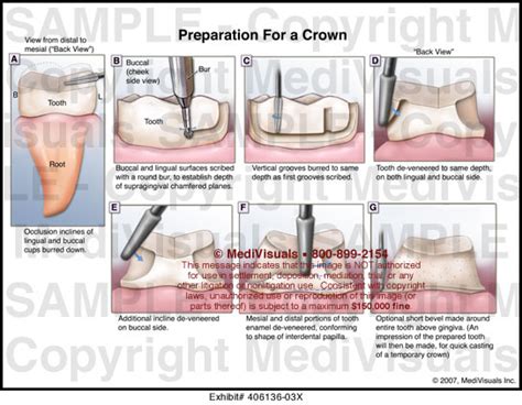 Medivisuals Preparation for a Crown Medical Illustration