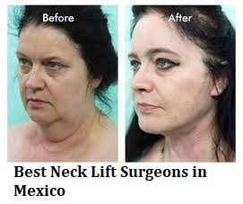 Neck Lift cost in Mexico - Find Best Surgeon, Reviews - Prices Year 2022 - MedContour