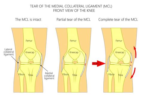 MCL Surgery for Athletes with Injuries & Tears