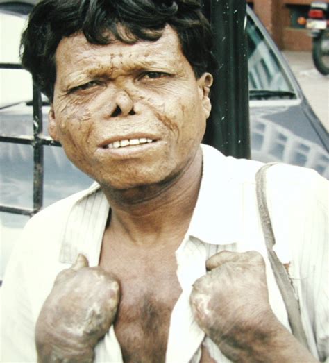 DIAGNOSTIC: leprosy