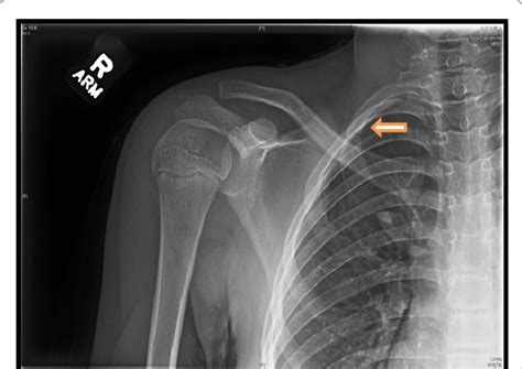 First rib fracture from Case 2. | Download Scientific Diagram