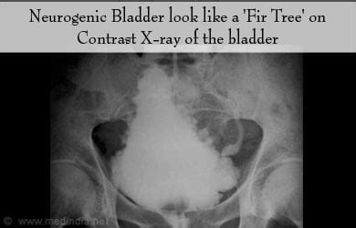 Neurogenic Bladder - Causes, Symptoms, Diagnosis, Treatment