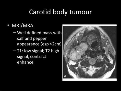 Paraganglioma