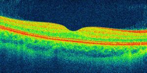 Normal Macula