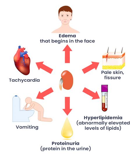 Ascites In Nephrotic Syndrome