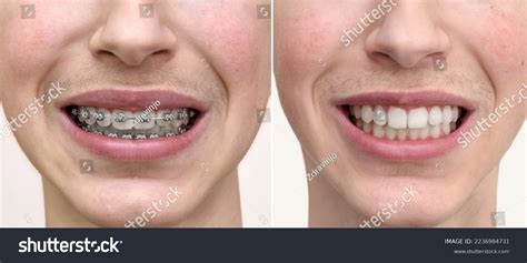 460 Dental Braces Before After Images, Stock Photos & Vectors | Shutterstock