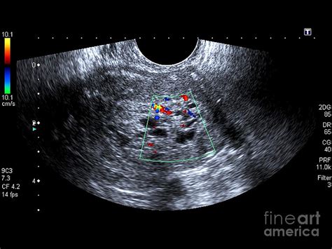 Postmenopausal Bleeding, Ultrasound Scan Photograph by Science Photo ...