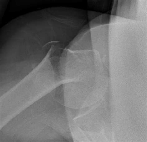 Shoulder and Elbow Surgery: Shoulder subluxation after proximal humerus fracture