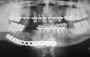 Mandibular Fracture X Ray