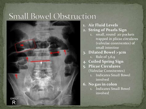 Small bowel obstruction (1)