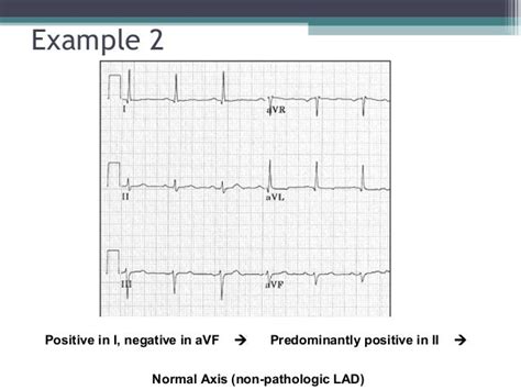 Ecg for beginners