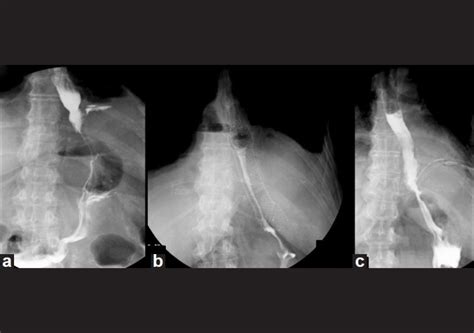 Case of Collis Gastroplasty: Radiologic pictures showing leak (a ...