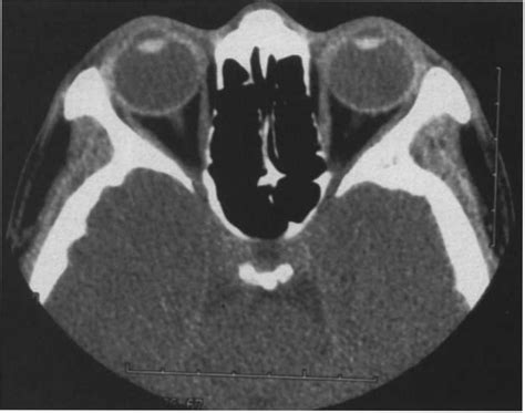 High-resolution CT scan of the orbits failed to demonstrate the ...