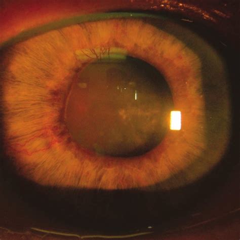 (PDF) Neovascular Glaucoma: Etiology, Diagnosis and Prognosis