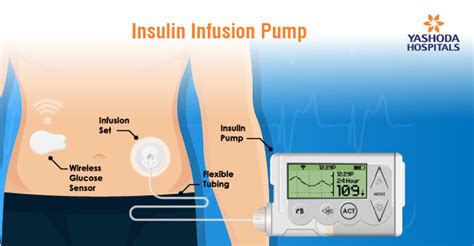 Insulin Pumps and CGM Sensors: Effective Diabetes Management