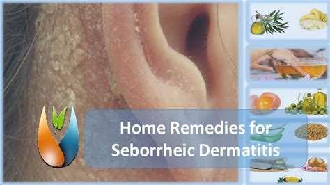 Home Remedies for Seborrheic Dermatitis - YouTube