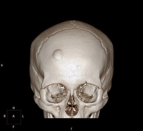 Skull Osteoma Ultrasound