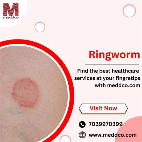 Understanding Ringworm: Causes, Symptoms, and Treatments