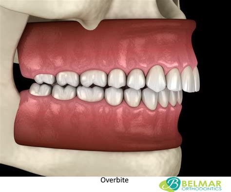 Overbite Teeth: What is an overbite or Buck Teeth?, Treatment, Causes ...