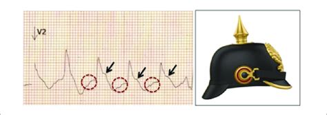 -Main SHS findings on ECG. An upward isoelectric line (red circles) is... | Download Scientific ...