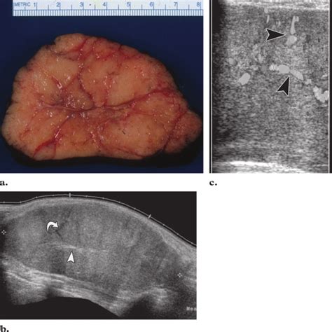 Juvenile fibroadenoma in a 15-year-old girl. (a) Photograph of ...