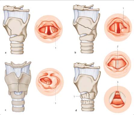 Diagnosing Injuries of the Larynx and Trachea | Ento Key