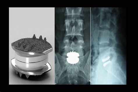 An Overview Of Artificial Cervical Disc Replacement Surgery