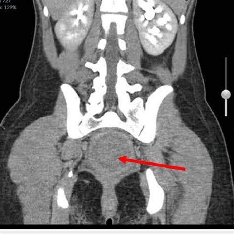 A) Normal vaginal anatomy hemipelvis. B) Vaginal agenesis of the lower... | Download Scientific ...