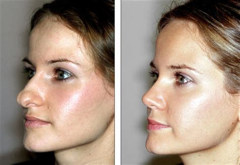 Before And After Pictures Show How A Nose Job Can Change Your Face | Others