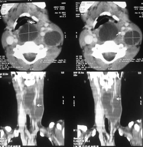 CT scan neck axial view and coronal reconstruction view showing a ...