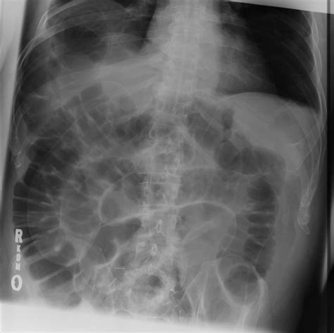 Abdominal X-ray Interpretation (AXR) | Radiology | OSCE | Geeky Medics