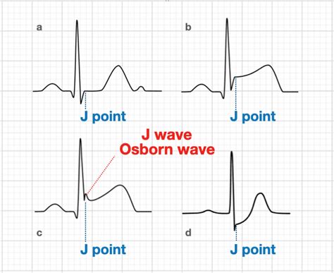 Osborn Wave (J Wave) • LITFL • ECG Library Basics