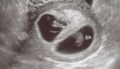 The Twins First Trimester Checklist | Twiniversity #1 Parenting Twins Site