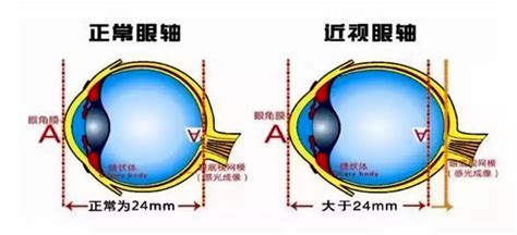 人为什么会近视_近视眼形成的原理是什么？_十万个为什么