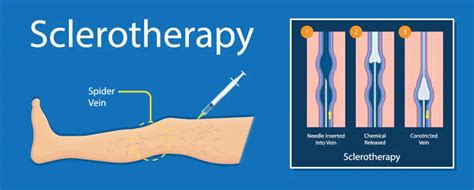 Varicose Vein Removal Long Island | Sclerotherapy Long Island