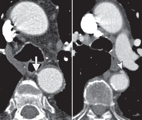 Bronchial Arteries: Anatomy, Function, Hypertrophy, and Anomalies | RadioGraphics