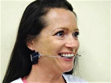 Headgear Braces Adults | Use Braces