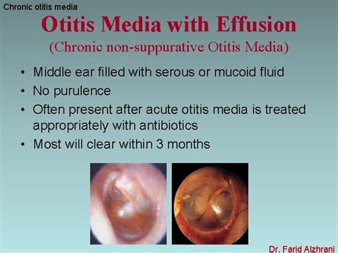 Otitis Media Icd 10