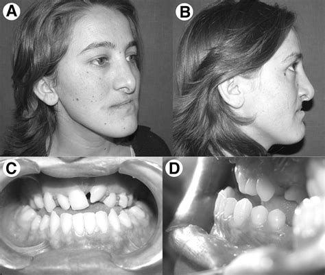 Maxillary Anterior Segmental Advancement of Hypoplastic Maxilla in Cleft Patients by Distraction ...