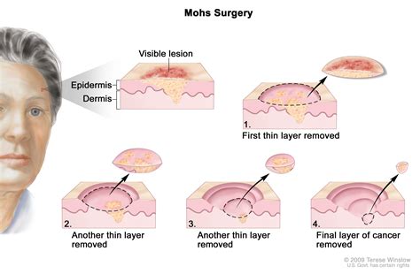 Skin Cancer Treatment - NCI