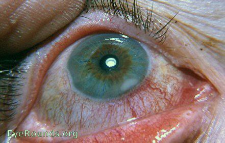 Marginal keratitis. EyeRounds.org: Online Ophthalmic Atlas