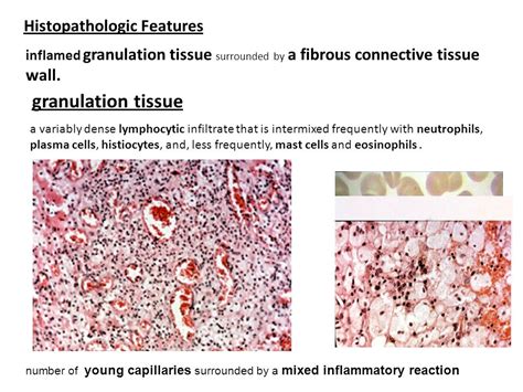 Periapical Granuloma Histology