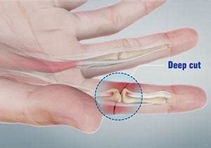 Flexor Tendon Injuries Carmel IN | Flexor Tendon Repair Indianapolis IN