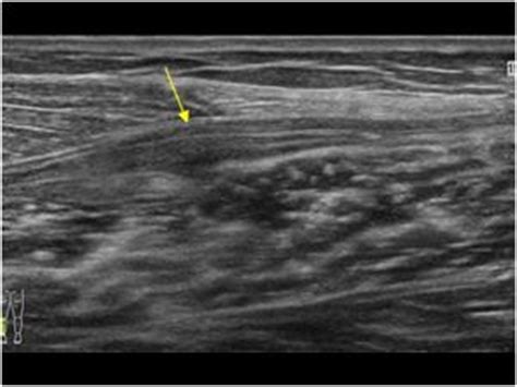 Musculoskeletal, bone, muscle, nerves and other soft tissues | 7.2 Muscle : Case 7.2.6 Plantaris ...