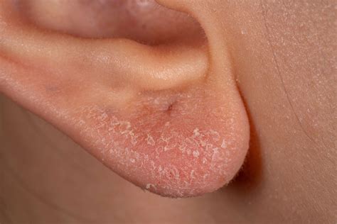 Ear Eczema: Causes, Symptoms, Treatment and Prevention