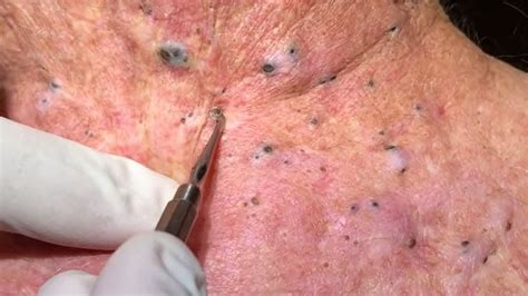 AWESOME EXTRACTION BLACKHEADS -PART25- - YouTube