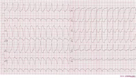 File:12lead vt1.jpg - ECGpedia