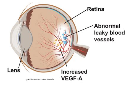 Treatment for Wet Age-related Macular Degeneration - AMD