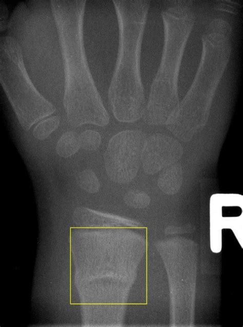 A buckle fracture of the distal radius. The classification is... | Download Scientific Diagram